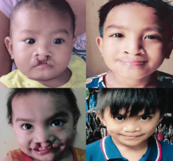 cleft palate icon